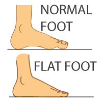 Plantar Fasciitis | Arch Support