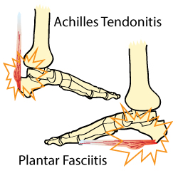 Plantar Fasciitis Vs Achilles Tendonitis