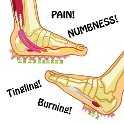 Signs of Plantar Fasciitis and Tarsal Tunnel Syndrome